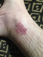 One Week Post Stings